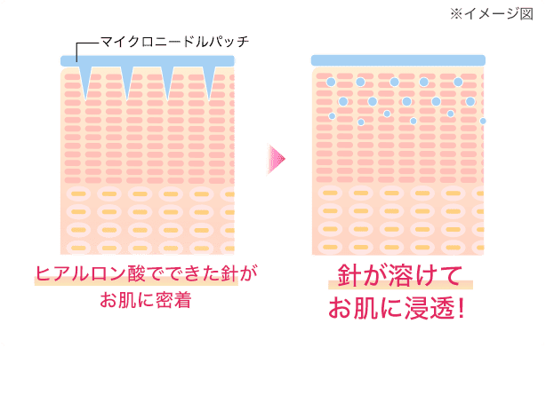 マイクロニードル（ヒアルロン酸でできた針）がお肌に密着し、ハリが溶けてお肌に浸透！のイメージ図